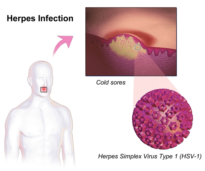 id-6-HSV-Herpes_Infection-1200X1000-min.jpg