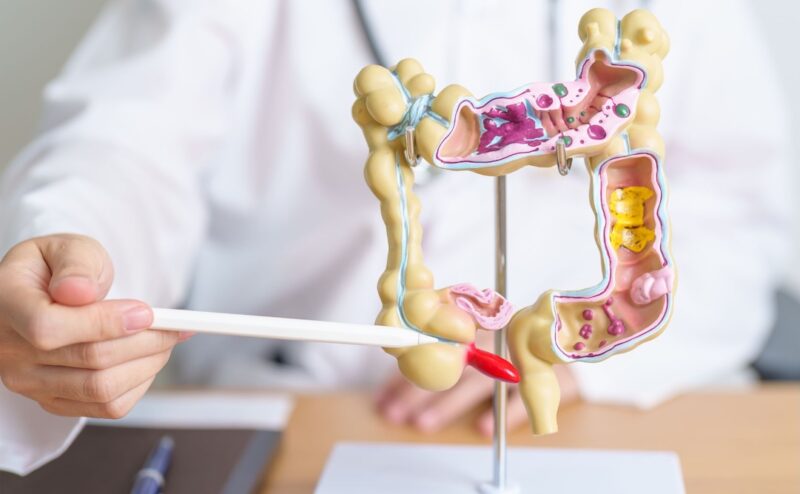 modello intestino con tratto infiammato